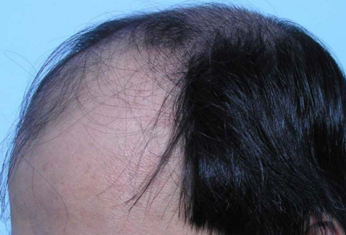 造成女性脱发的原因都有哪些?文章图片1