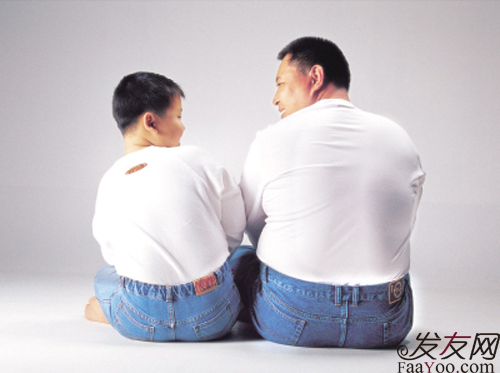 什么是肥胖性脱发,肥胖型脱发是怎么回事?文章图片2