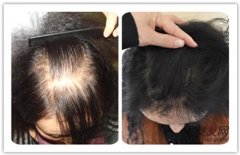 疤痕性脱发是怎么回事，应该如何治疗好
