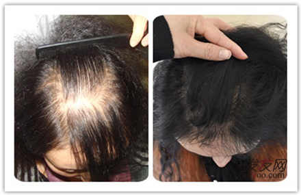 疤痕性脱发是怎么回事，应该如何治疗好文章图片