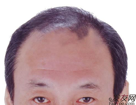 如何预防男性型脱发的发生？文章图片2