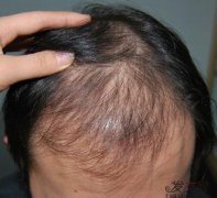 感染性脱发是怎么回事，感染性脱发预防