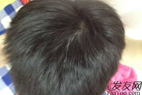 病理性脱发应该怎么办,文章图片2