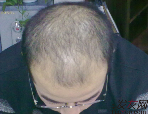 病理性脱发包含哪几种脱发类型,文章图片1