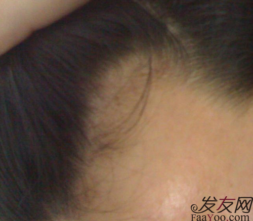 病理性脱发包含哪几种脱发类型，文章图片2