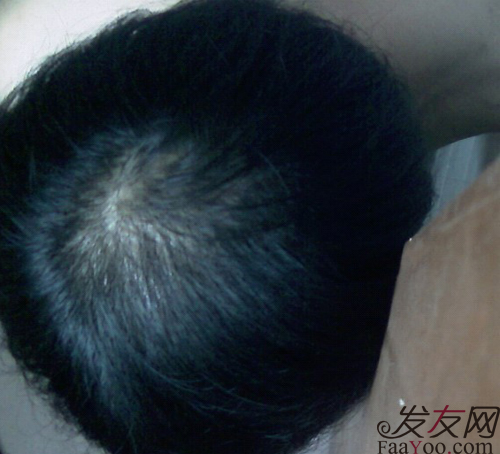 病理性脱发需要合理饮食,文章图片1