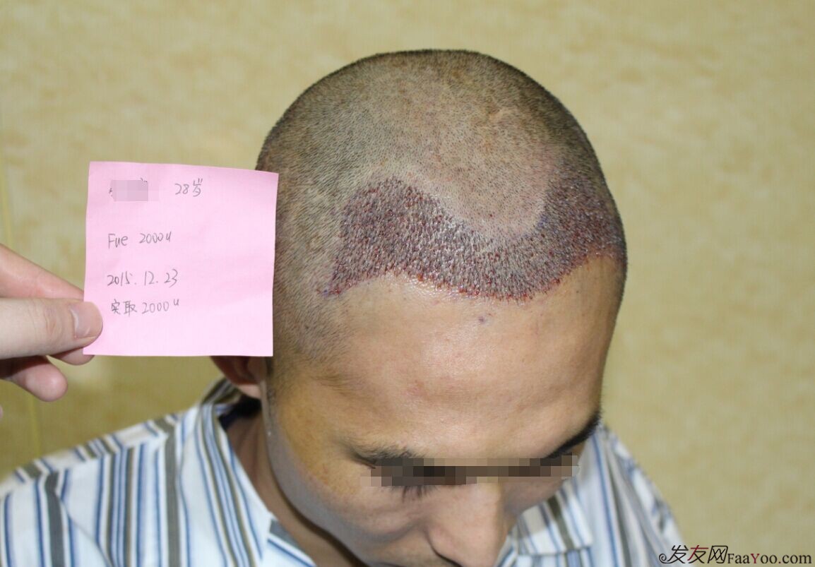 雍禾植发