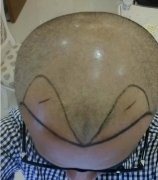 我脱发到植发的真实经历