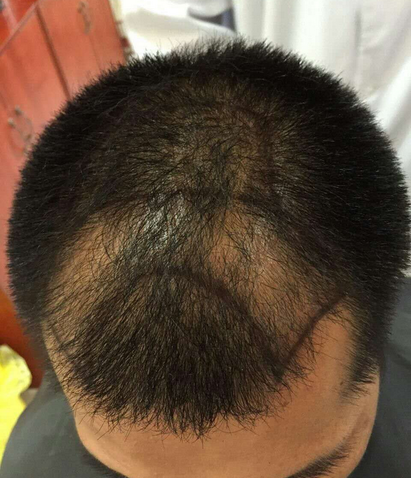 雍禾植发