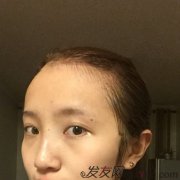 美女发际线移植（多图）