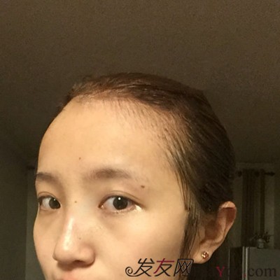 发际线植发
