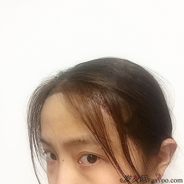 发际线移植