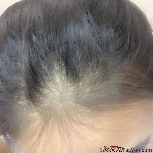 发际线植发