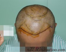 经过反复折腾，最终选择了上海瑞丽诗植发