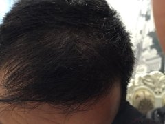 科发源植发，术后第九天分享帖