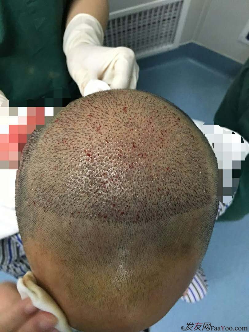雍禾植发