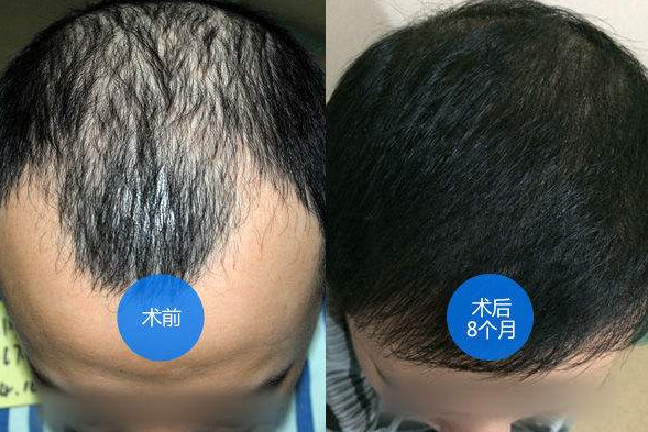 常见脂溢性脱发怎么治疗有效呢?