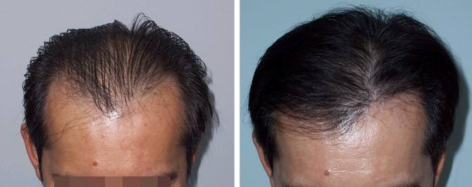 植发加密手术会不会影响原生发的健康呢？？？ 