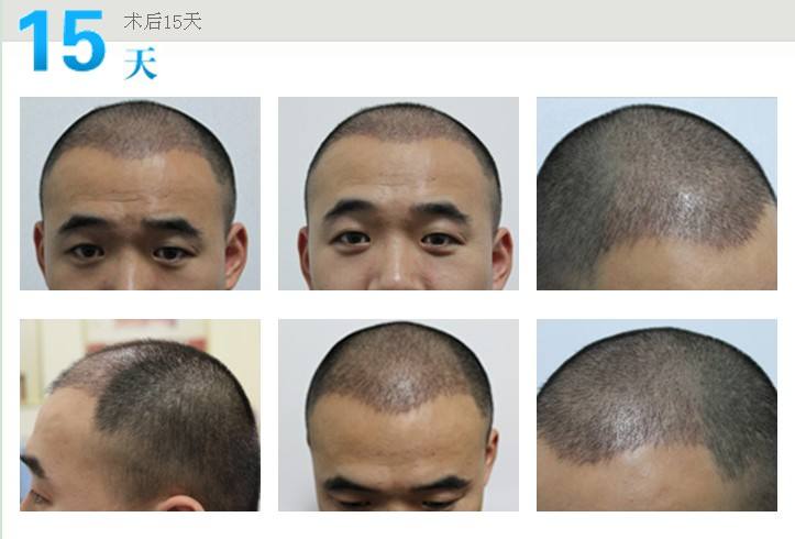 为什么植发后,种植区头发会暂时脱落,这主要是三个方面影响!