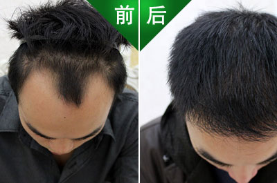 发哥讲解:很多发友都理解错了!植发并不是“拆东墙补西墙”!