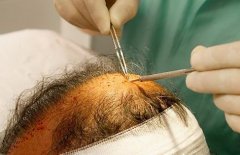 为什么有些人做完植发后，反而脱发更加严重了？