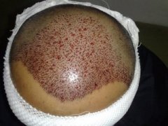 植发后伤口会很难愈合留下疤痕吗？