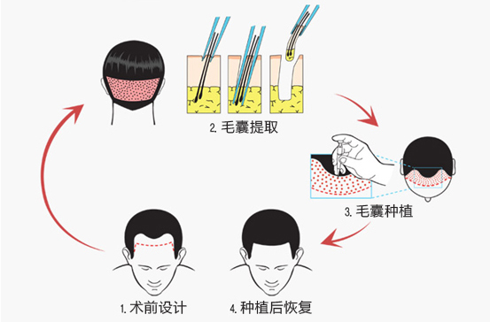 这些植发技术的不同之处你知道吗？ 