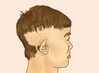 疤痕性脱发的植发效果好吗？ 