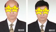 植发几年后效果还能保持吗