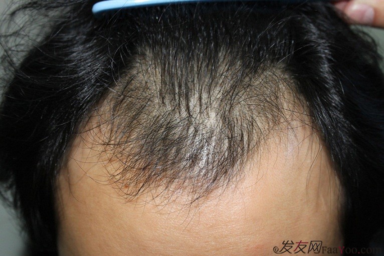 头发加密植发手术前后这些事项你知道吗？ 