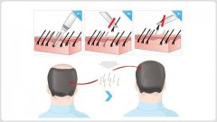 无痕植发技术怎么样？无痕植发技术讲解