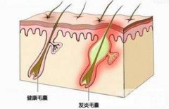 毛囊坏死能植发吗？毛囊坏死怎么办？