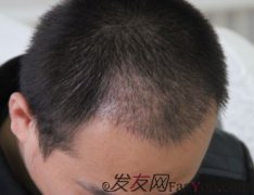  植发后的脱落期是绝对的吗？