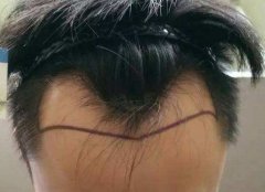 种植头植发仪器有哪些？