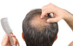 脂溢性脱发植发有用吗？