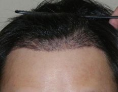 植发手术值得信赖吗？