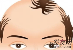 年轻人脱发与疾病有关吗？