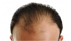如何改善脂溢性脱发？