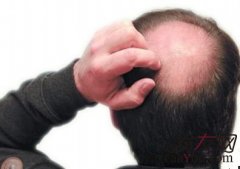 慢性脂溢性脱发怎么办？