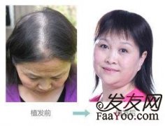 术后怎么正确护理头发