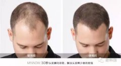 脂溢性脱发的福音