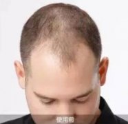 我的头发什么时候才能好