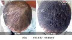 “大脑门”的苦恼