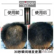 脱发让我苦不堪言