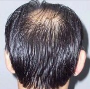 论头发的重要性