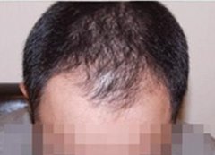 一位老师的脱发经历