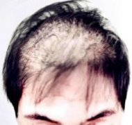 脱发是把杀猪刀