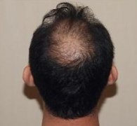 脱发耽搁不起啊