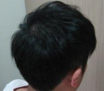 感谢脱发让我找到了女友