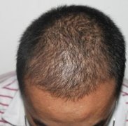 脱发其实并不可怕